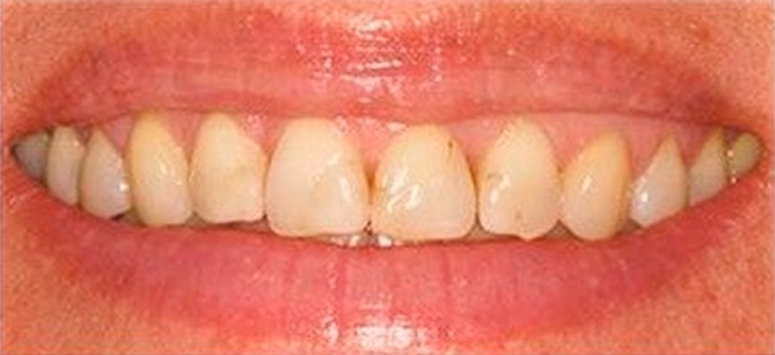 Почему возникают волнистые края у передних зубов? | Стоматология Smile-at-Once | Дзен