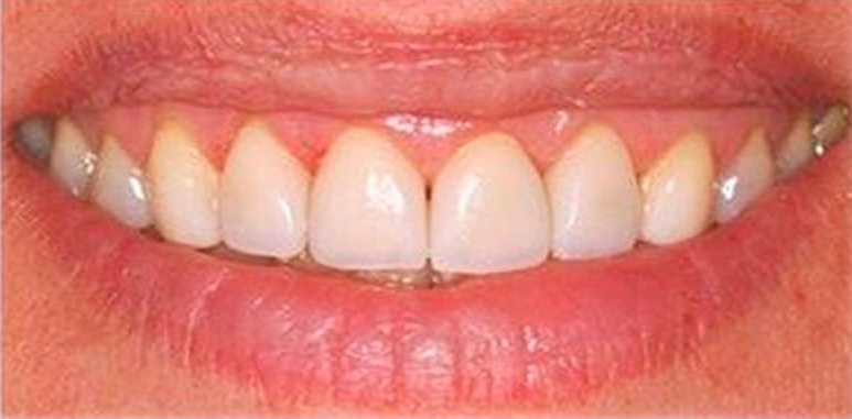 Почему возникают волнистые края у передних зубов?
